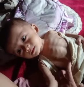 Diduga Bayi Penderita Gizi Buruk di Kalianda Terkesan Luput Dari Pantauan Pemerintah